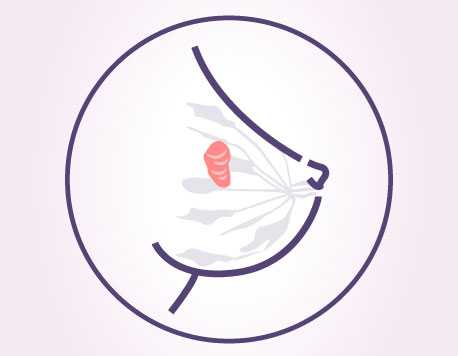 fibroadenoma