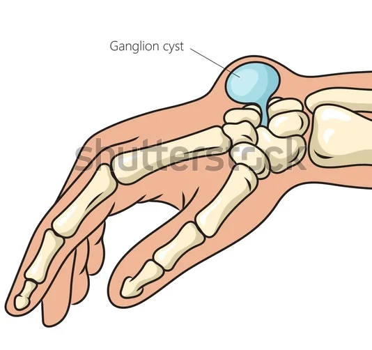 ganglion cyst structure disease diagram 600w 2333237291 e1747899915177