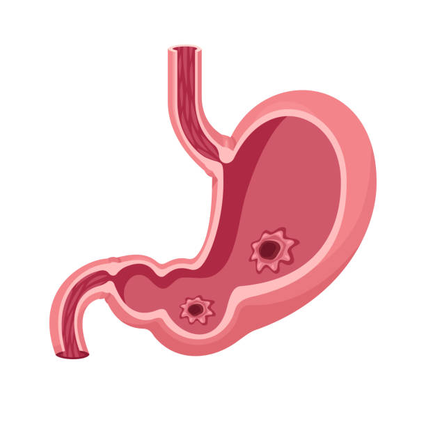 human stomach vector. peptic ulcer.